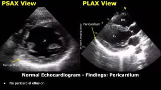 Echocardiography Reporting  Heart Ultrasound  How To Write USG Reports  Cardiac Diseases [upl. by Steddman]