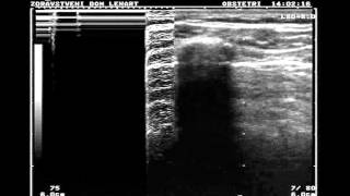 Normal lung vs pneumothorax [upl. by Cleveland]