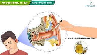 Foreign Body In The Ear 👂  ENT Lectures [upl. by Airlie]