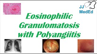 Eosinophilic Granulomatosis with Polyangiitis EGPA  ChurgStrauss Syndrome Autoimmune Vasculitis [upl. by Laidlaw]