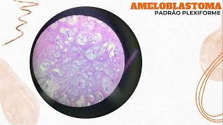 TUMORES ODONTOGÊNICOS AMELOBLASTOMA [upl. by Lidaa]