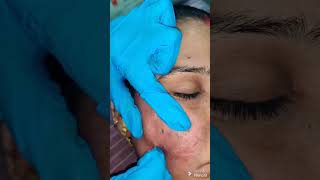 SUBCISION WITH MICRO NEEDLING RF FOR ACNE SCAR [upl. by Aiem870]