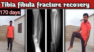 tibia fibula fracture recovery170 days todayfull knee bending exerciseThe Road To Recoveryhindi [upl. by Alul]