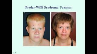 PraderWilli Syndrome  CRASH Medical Review Series [upl. by Dari771]