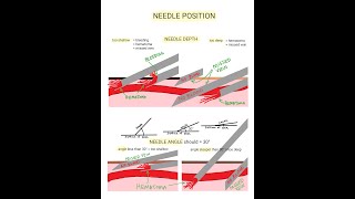 Venipuncture  How to Position a Needle [upl. by Yerg]