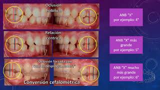 El mito del montaje en articulador semiajustable 2a parte [upl. by Octavian]