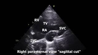 Right Parasternal Echo View [upl. by Cade276]