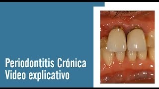 Periodontitis Crónica  Juan Salgado  Enfermedades Periodontales  Video explicativo [upl. by Dlaniger]