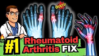 The Best Natural Treatment for Rheumatoid Arthritis [upl. by Jardena924]