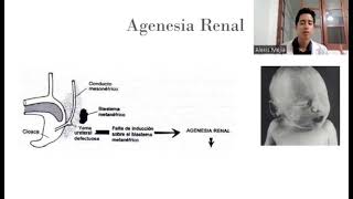 Agenesia Renal [upl. by Luhey123]