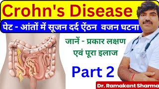 Crohns Disease A Comprehensive Guide to Diagnosis and Managementdrramakantsharma7 [upl. by Ennylyak]