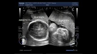 Ultrasound Video showing Polyhydramnios and other fetal anomalies [upl. by Nabi80]