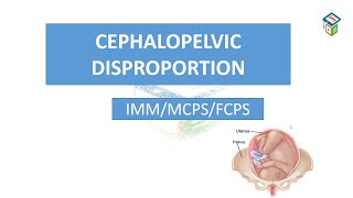 CPD  cephalopelvic disproportion  cpsp format  mcqs  labour module [upl. by Ahoufe448]