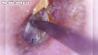 Ear Wax Removal 179 The ear canal is very narrow and small  Ear Cleaning ASMR [upl. by Gnim794]