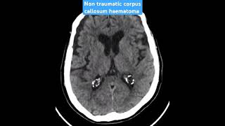 CT scan case 71 non traumatic corpus callosum haematoma ctscan radiology radiologist mri [upl. by Soloman]