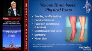 Diagnosis DVT and PE David Rigberg MD [upl. by Kohcztiy]