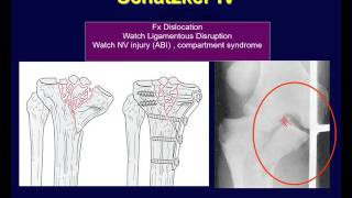 Tibial plateau fractures 2 [upl. by Blunk]