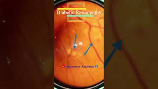 Diabetic retinopathy  Hemorrhages  cotton wool spots  Hard exudates  Fundus  Short Video 173 [upl. by Nodyarg]