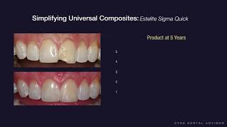 Simplifying Composite Restorations  Estelite Sigma Quick [upl. by Cassie402]