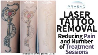 How Tattoos Removal can be Done with Less Pain and Fewer Treatment Sessions [upl. by Durman692]