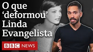 Criolipólise o procedimento estético que deformou modelo Linda Evangelista [upl. by Federica]