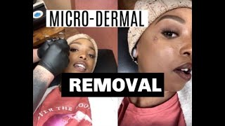 MicroDermal Piercing Removal  Piercing Update [upl. by Merl410]