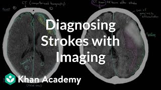 Diagnosing strokes with imaging CT MRI and Angiography  NCLEXRN  Khan Academy [upl. by Uah]