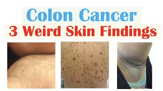 3 Weird Signs of Colon Cancer Found on the Skin [upl. by Norihs]