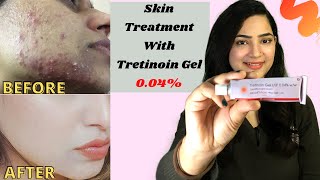 TRETINOIN Gel 004 Review Before And After Tretinoin Cream Review  RetinoA review myexperience [upl. by Talbert]