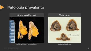 Imágenes de las Glándulas Suprarrenales [upl. by Leis]