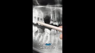 Do you need a bone graft if theres not enough bone [upl. by Temple]