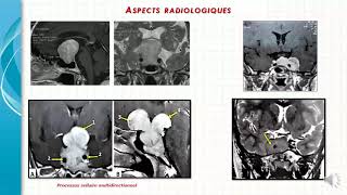 Tumeurs hypophysaires Dr Faraoun [upl. by Aleiram448]