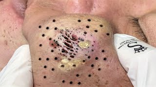 Blackhead Removal With Sac Dep Spa 1000339 [upl. by Rozek]