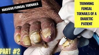 Massive Fungal Toenails  Trimming Fungal Toenails of a Diabetic Patient  Part 2 Podiatry [upl. by Wilde]