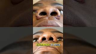 DISMINUCIÓN DE FOSAS NASALES 👃 alectomia nariz narizperfecta fosasnasales [upl. by Adev]