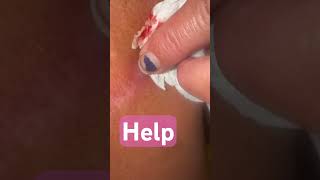 healing fungus mold skin morgellons disease alien implant health help faith raredisease [upl. by Zorana]