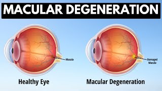 Macular degeneration Causes Signs and Symptoms Diagnosis and Treatment [upl. by Yrret]