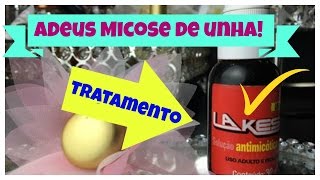 Acabei com a micose nas unhas usando LAKESIA 2016 [upl. by Yrruc]