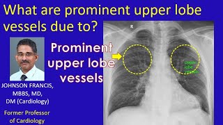 What are prominent upper lobe vessels due to [upl. by Netsirhc]