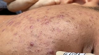 ACNE TREATMENT BO NGUYỄN  Blackheads amp Whiteheads Removal 2024 [upl. by Khalil]