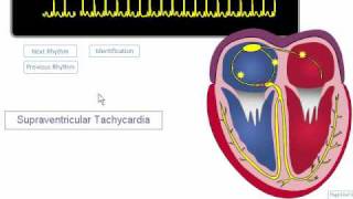 ECG Rhythm Review SVT Atrial Fibrillation Atrial Flutter [upl. by Ardnuasal696]