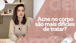 Acne no corpo entenda sobre as espinhas nas costas ombros e colo [upl. by Hornstein]