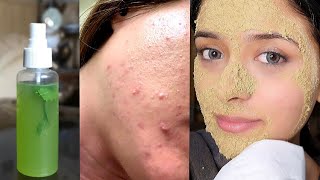 5 Days Challenge  Remove White Bumps  After 1 Use Visible Spotless Bright Skin [upl. by Garth210]