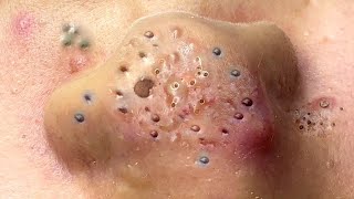 Big Cystic Acne Blackheads Extraction Blackheads amp Milia Whiteheads Removal Pimple Popping  188 [upl. by Naed]