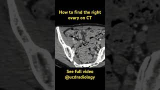 Right ovary on CT radiologyresident medicine radres doctor medicalstudent radiology [upl. by Aiello]