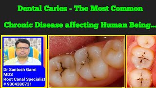 Dental Caries  The Most Common Chronic Disease affecting Human Being [upl. by Latini184]