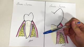 ETIOPATOGENIA DE LAS ENFERMEDADES PERIODONTALES [upl. by Haerb]