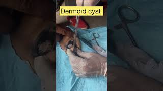 Dermoid cyst l dr Umar Khan [upl. by Srini]