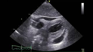 経胸壁心エコー図 心タンポナーデ 2 心窩部四腔像 [upl. by Suzzy]