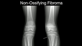 NonOssifying Fibroma 1 [upl. by Waldack]